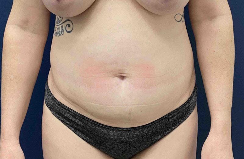 Tummy Tuck Before & After Image