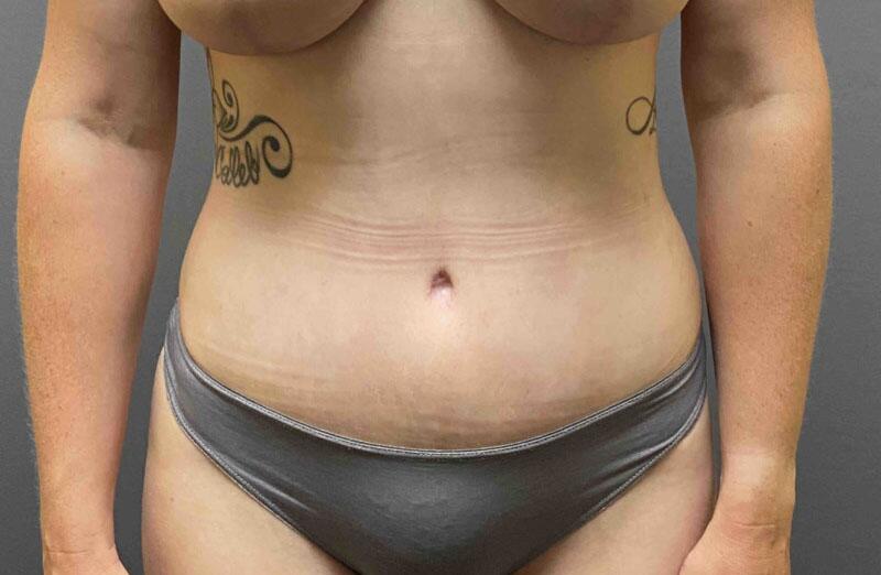 Tummy Tuck Before & After Image