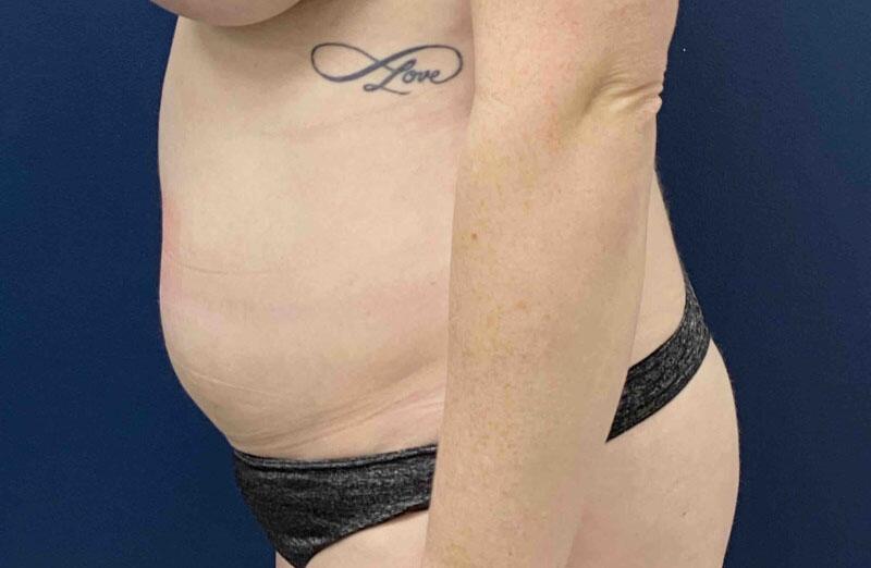 Tummy Tuck Before & After Image