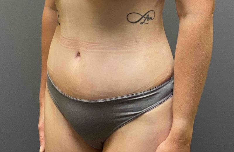 Tummy Tuck Before & After Image