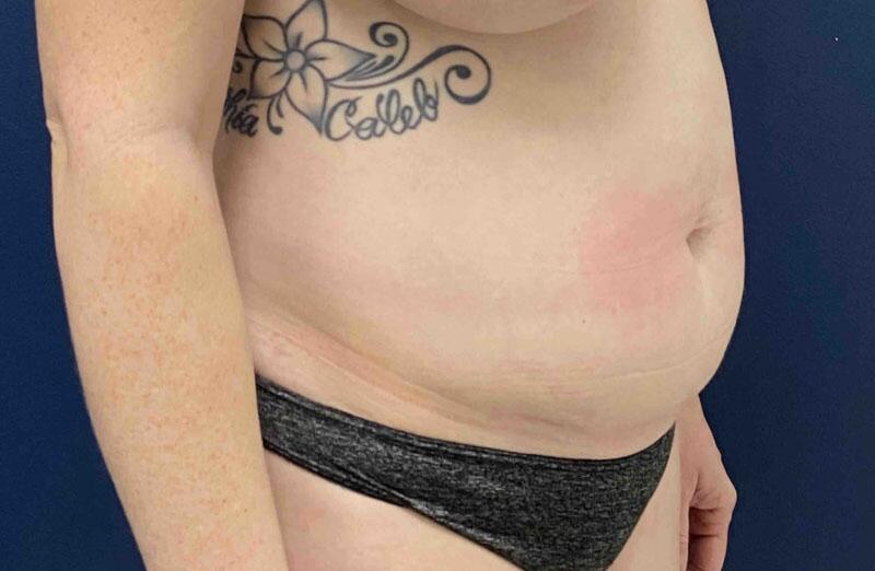 Tummy Tuck Before & After Image