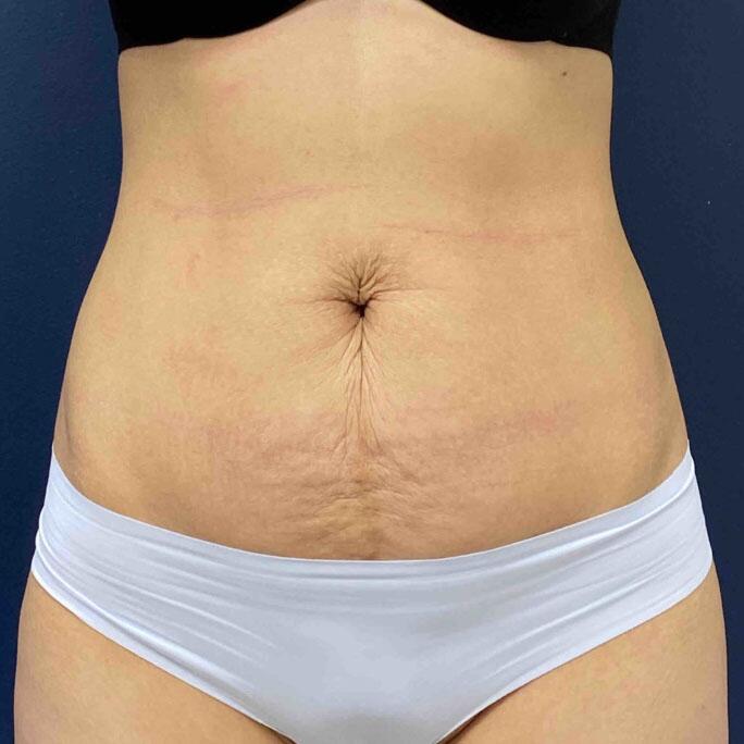 Tummy Tuck Before & After Image