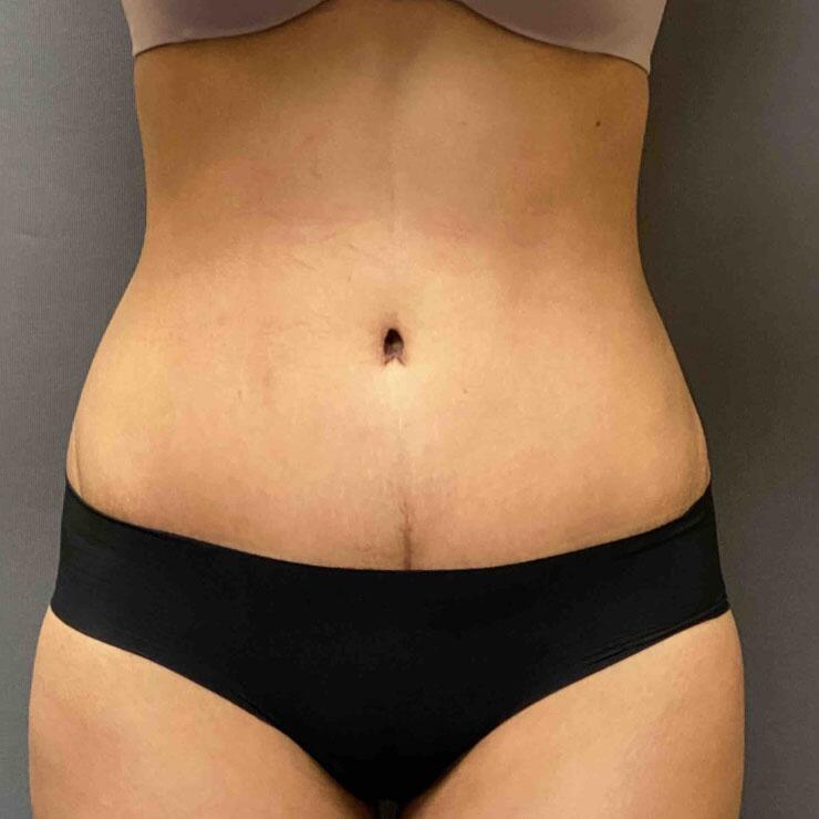 Tummy Tuck Before & After Image