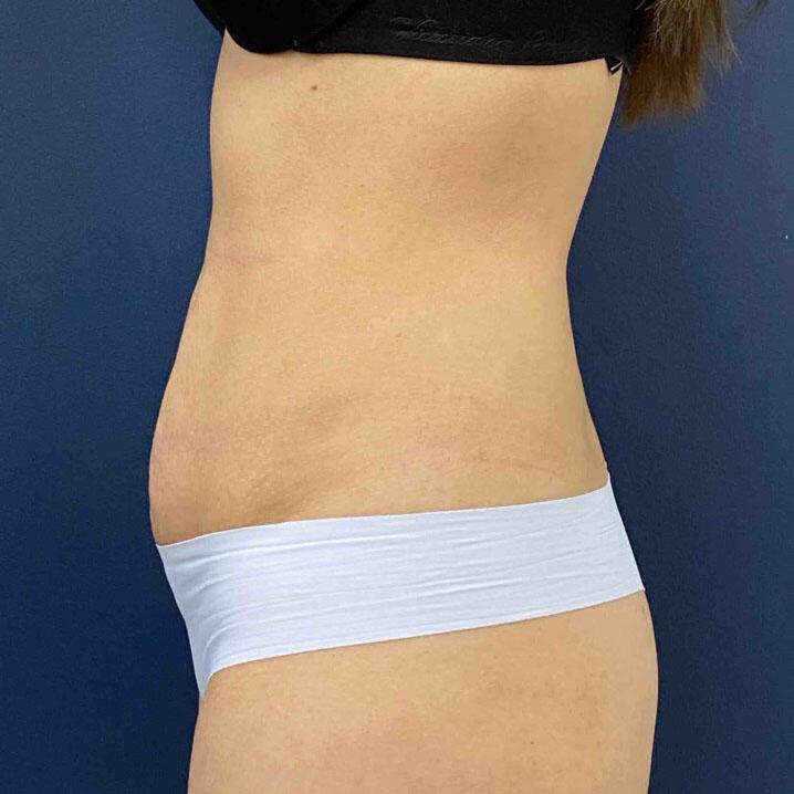 Tummy Tuck Before & After Image