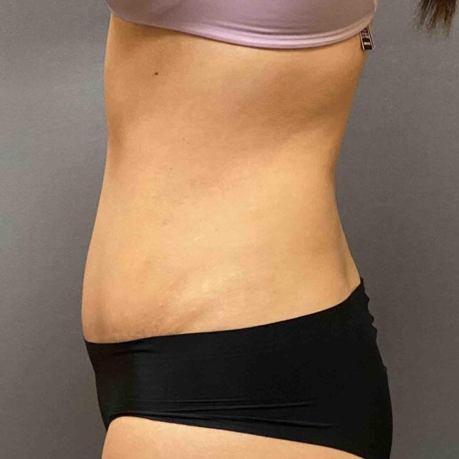 Tummy Tuck Before & After Image