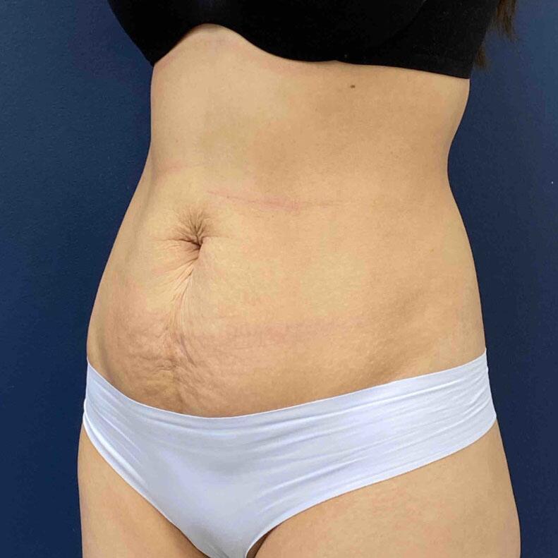 Tummy Tuck Before & After Image