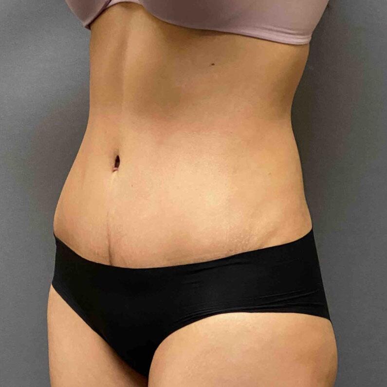 Tummy Tuck Before & After Image