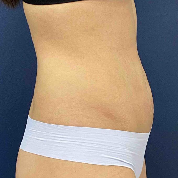 Tummy Tuck Before & After Image