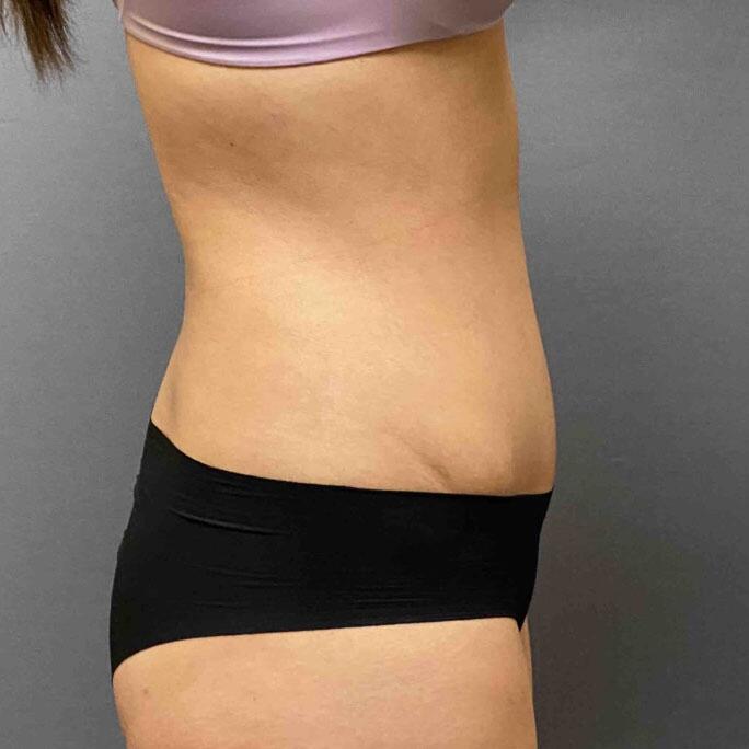 Tummy Tuck Before & After Image