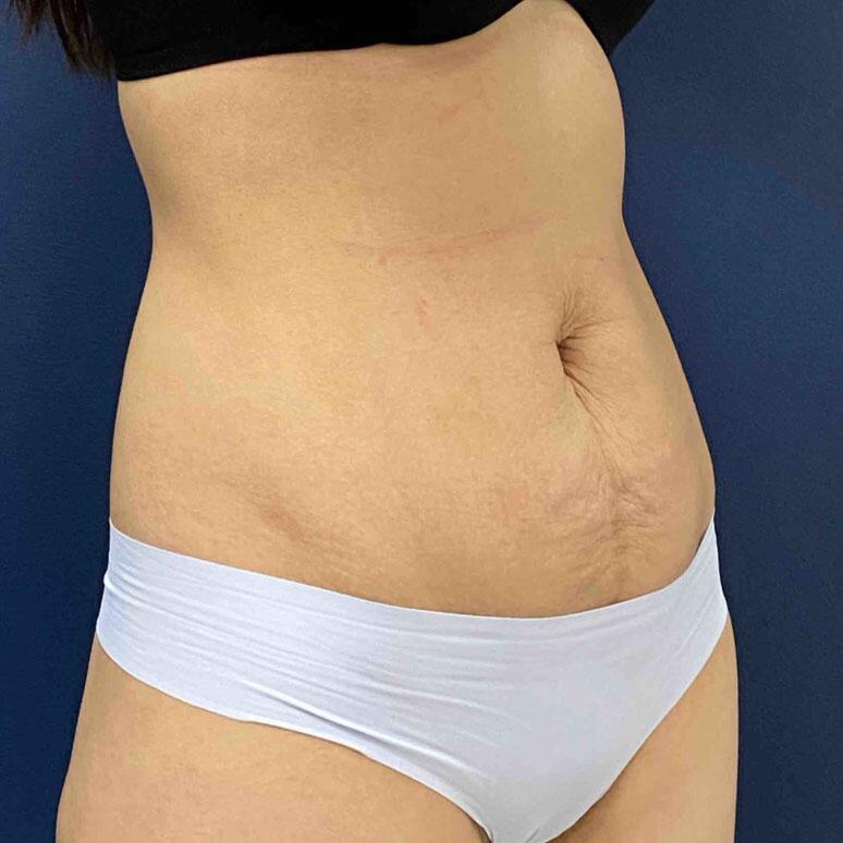 Tummy Tuck Before & After Image