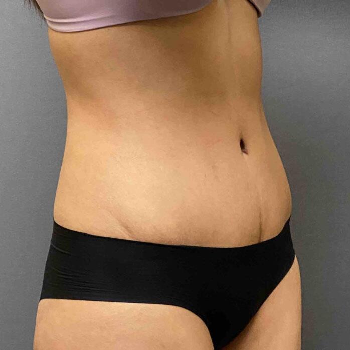 Tummy Tuck Before & After Image