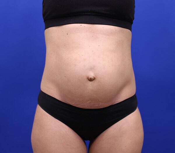 Tummy Tuck Before & After Image