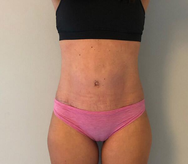 Tummy Tuck Before & After Image