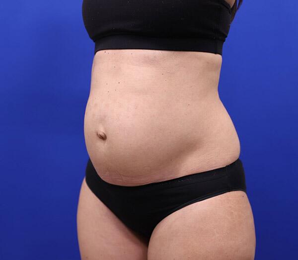 Tummy Tuck Before & After Image