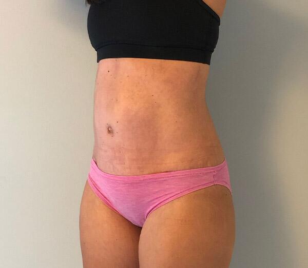 Tummy Tuck Before & After Image