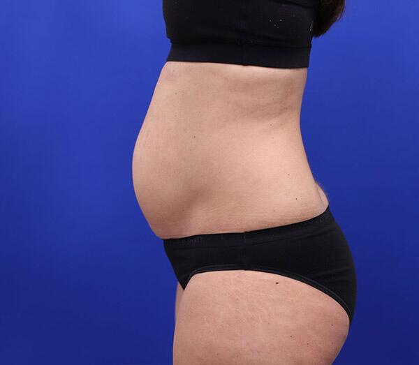 Tummy Tuck Before & After Image