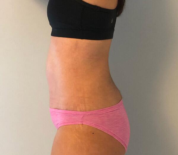 Tummy Tuck Before & After Image