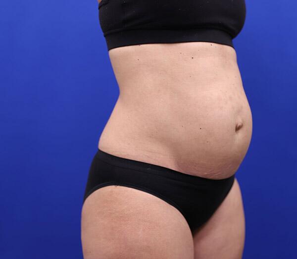 Tummy Tuck Before & After Image