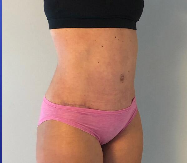 Tummy Tuck Before & After Image