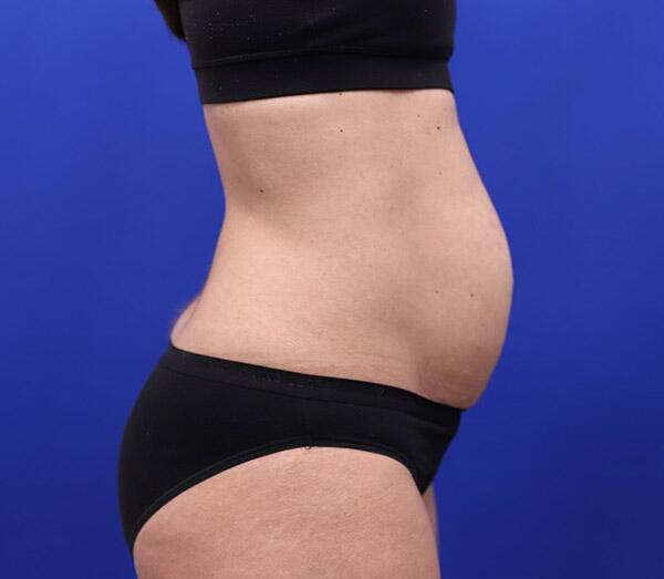 Tummy Tuck Before & After Image