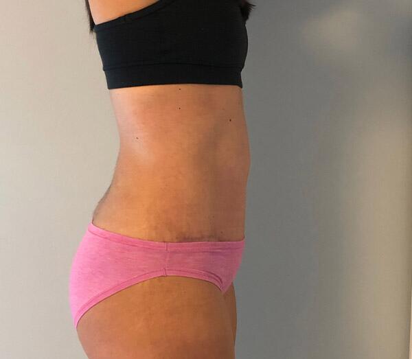 Tummy Tuck Before & After Image