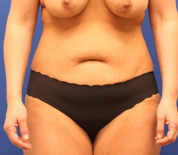 Tummy Tuck Before & After Image