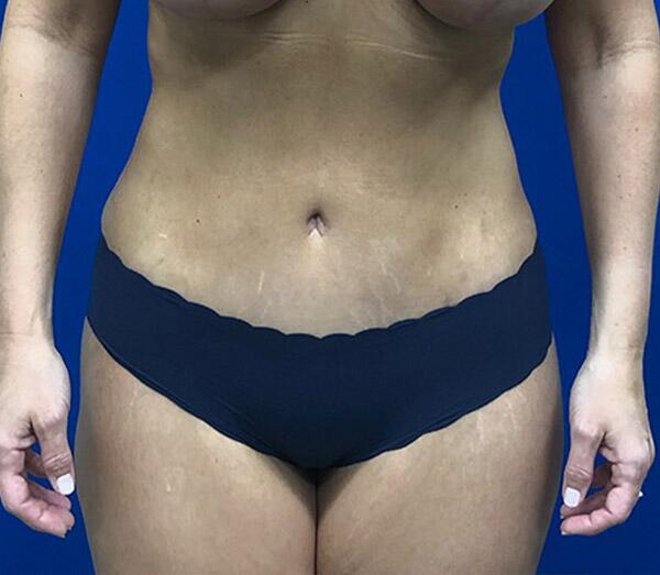 Tummy Tuck Before & After Image