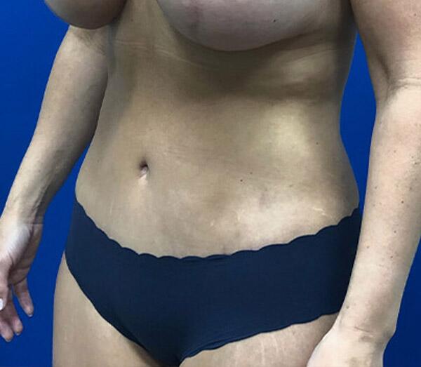 Tummy Tuck Before & After Image