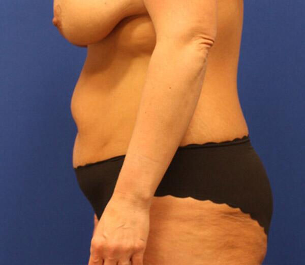 Tummy Tuck Before & After Image