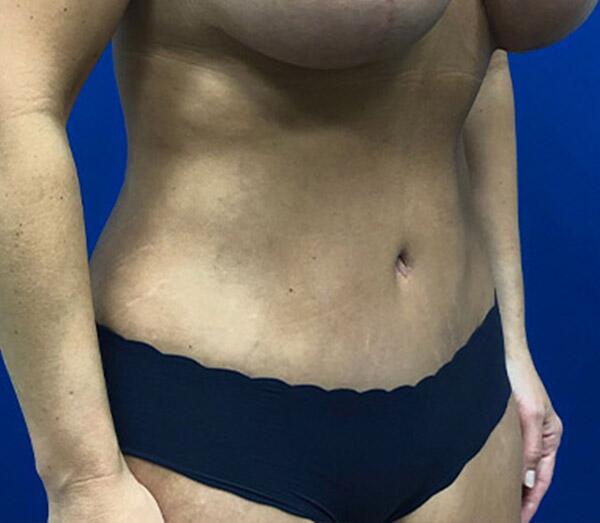 Tummy Tuck Before & After Image