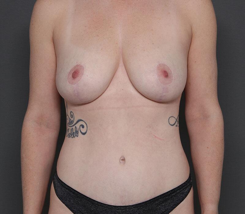 Tummy Tuck Before & After Image