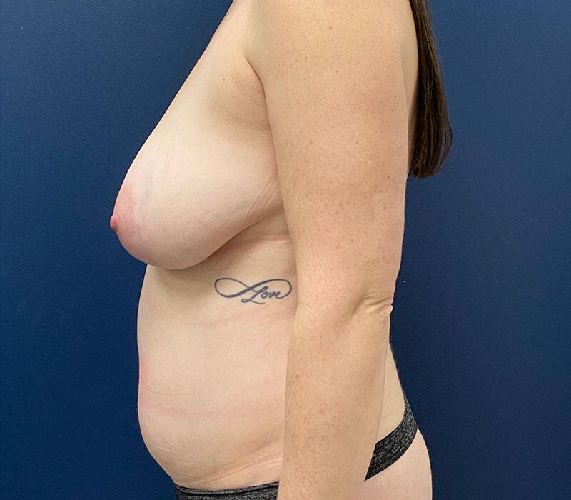 Tummy Tuck Before & After Image