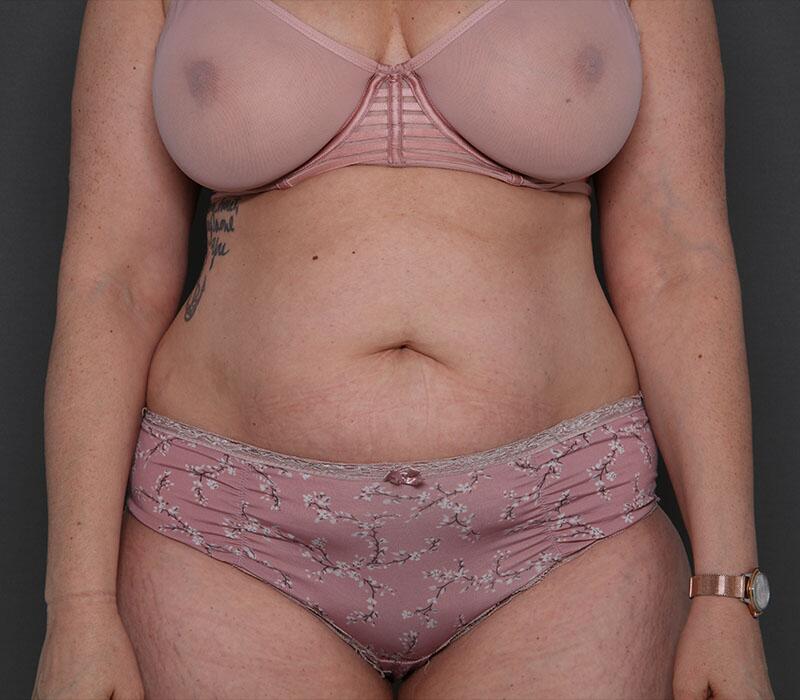 Tummy Tuck Before & After Image