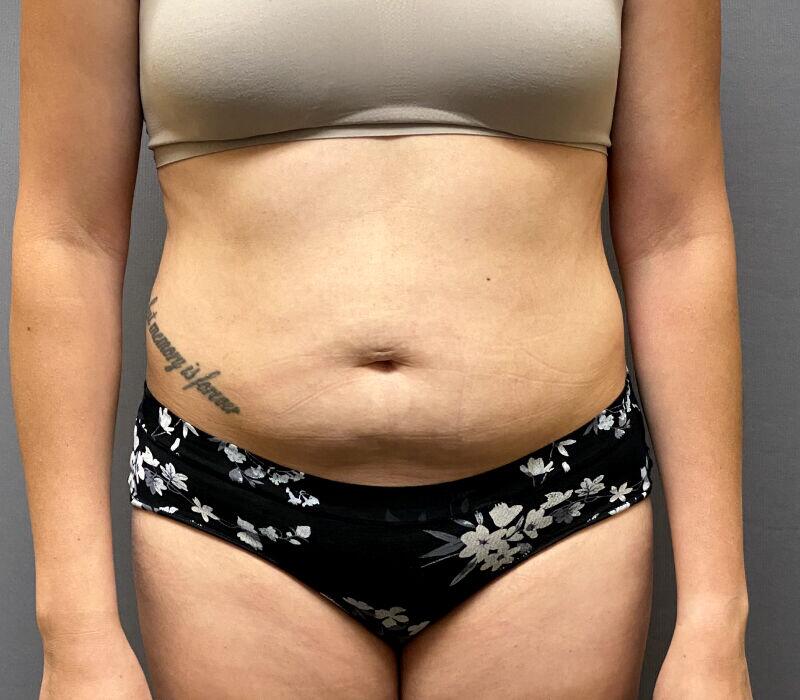 Tummy Tuck Before & After Image