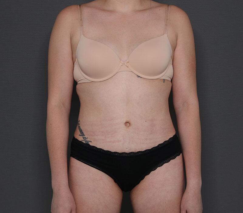 Tummy Tuck Before & After Image