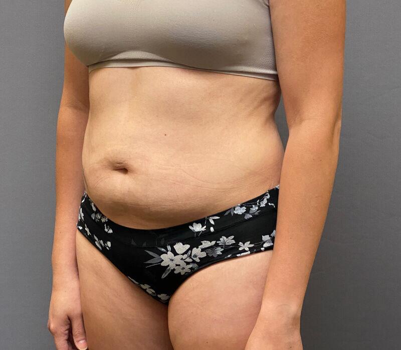 Tummy Tuck Before & After Image