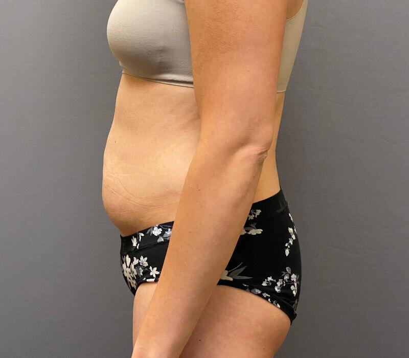 Tummy Tuck Before & After Image