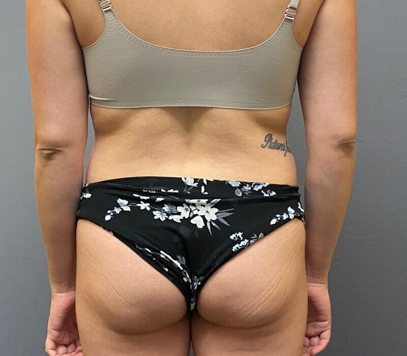 Tummy Tuck Before & After Image