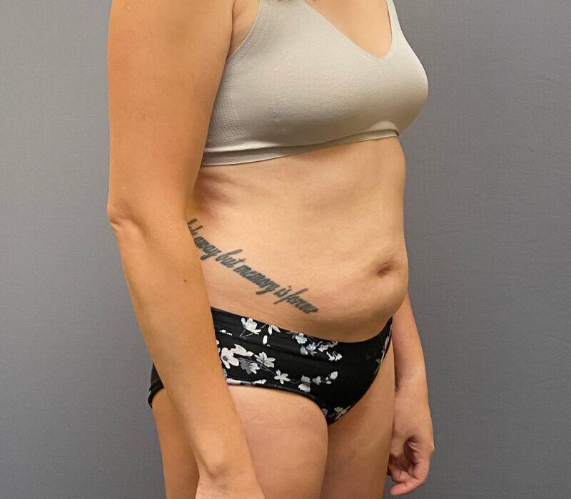 Tummy Tuck Before & After Image