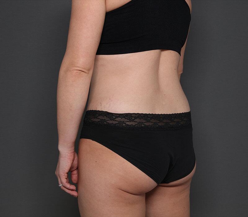 Tummy Tuck Before & After Image