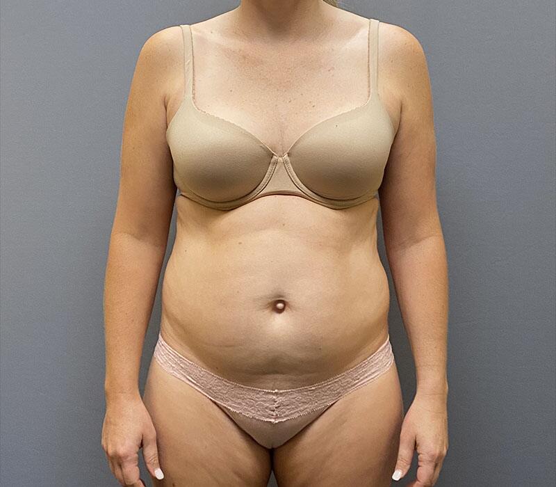 Tummy Tuck Before & After Image