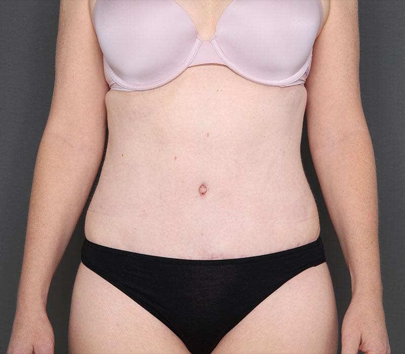 Tummy Tuck Before & After Image