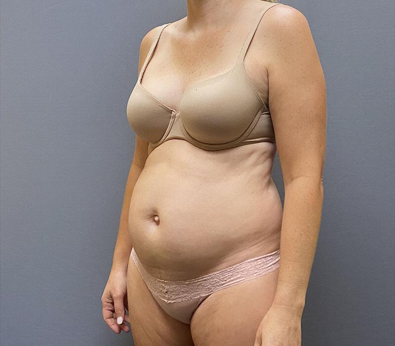 Tummy Tuck Before & After Image