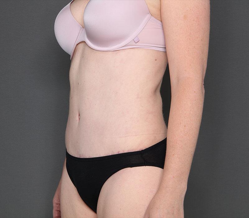 Tummy Tuck Before & After Image