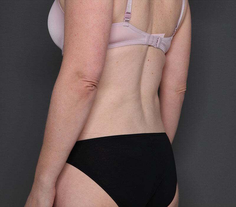 Tummy Tuck Before & After Image