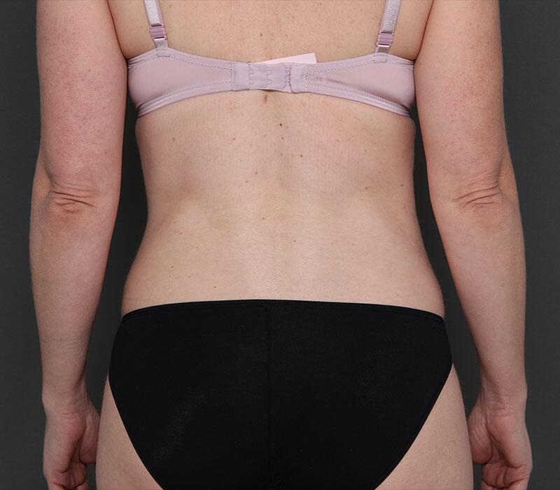 Tummy Tuck Before & After Image