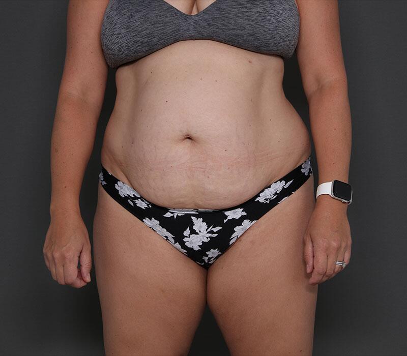 Tummy Tuck Before & After Image