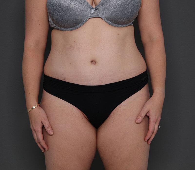 Tummy Tuck Before & After Image