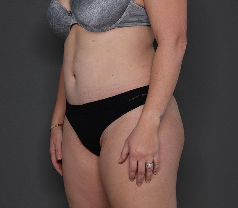 Tummy Tuck Before & After Image