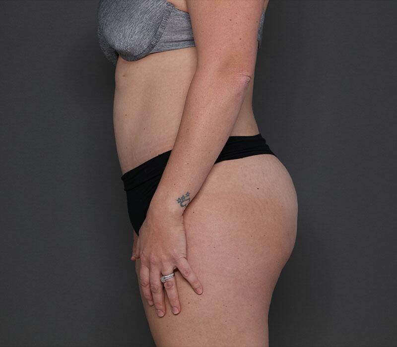 Tummy Tuck Before & After Image